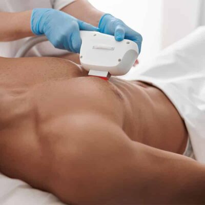 Man getting laser hair removal on chest.