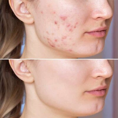 Acne before and after photo