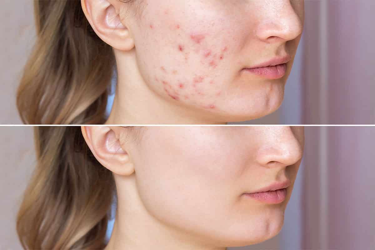The Truth About Light Based Acne Therapy