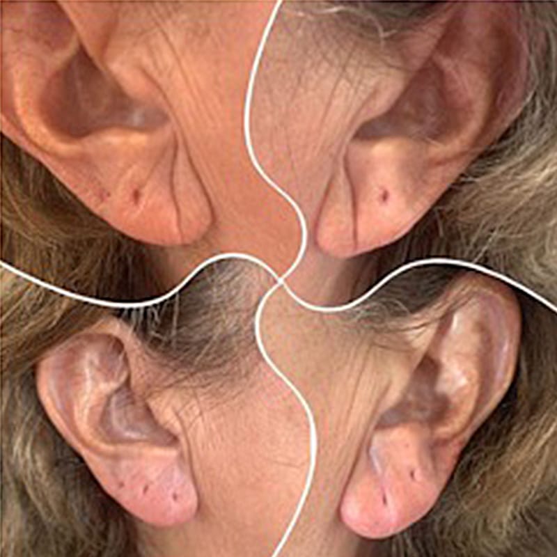 earlobe before and after