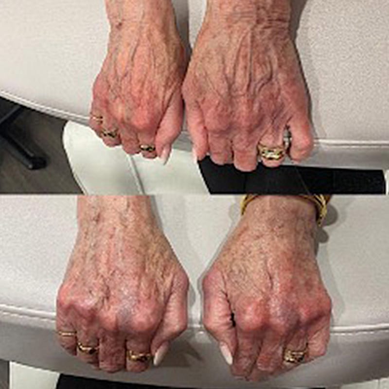 hand rejuvenation before and after