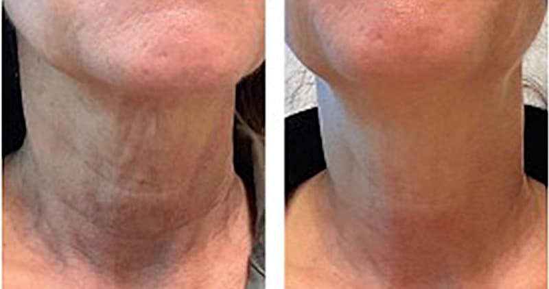 neck tox before and after