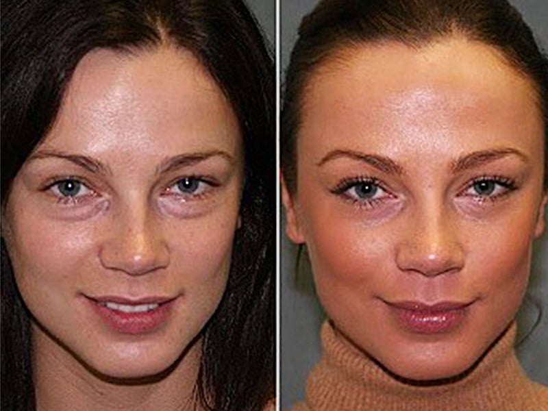 vampire facial before and after